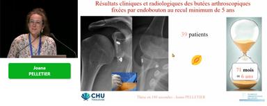 Résultats cliniques et radiologiques des butées arthroscopiques par endobouton (recul min de 5 ans)