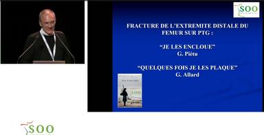 FRACTURE DE L'EXTREMITE DISTALE DU FEMUR SUR PTG