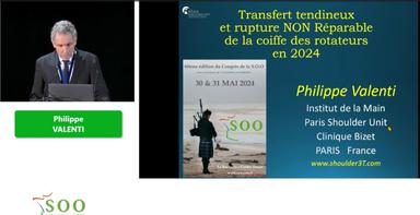 Traitement des ruptures de la coiffe non réparable, mon évolution durant ma carrière professionnelle